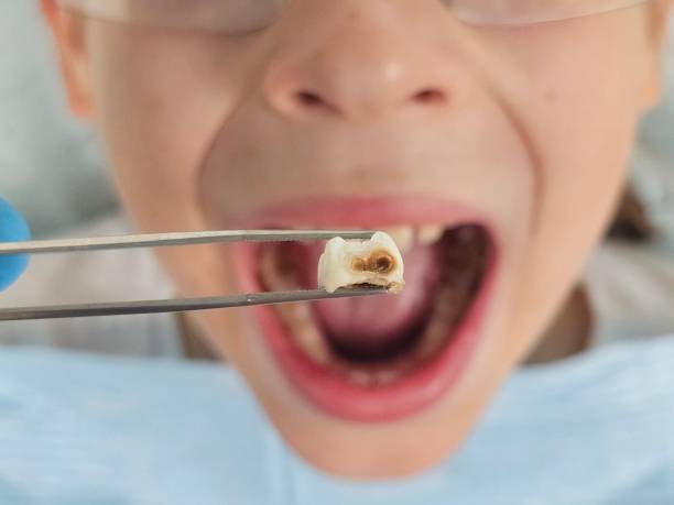 Best Emergency Tooth Extraction in Dana, NC